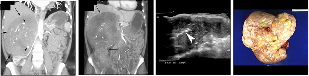 Primary tumor of the IVC